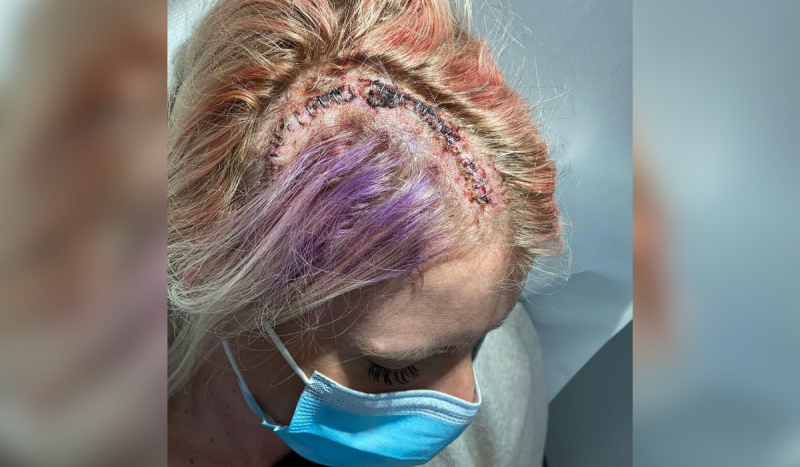 Foto de uma cabeça de mulher vista de cima com grande cicatriz de cirurgia para remoção de massa no cérebro